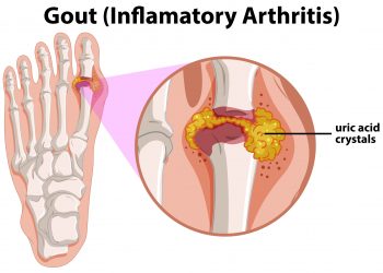 Cara Mencegah Asam Urat yang Efektif