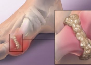 Catat, Ternyata ini Pantangan Bagi Penderita Asam Urat, Salah Satunya Kopi dan Teh