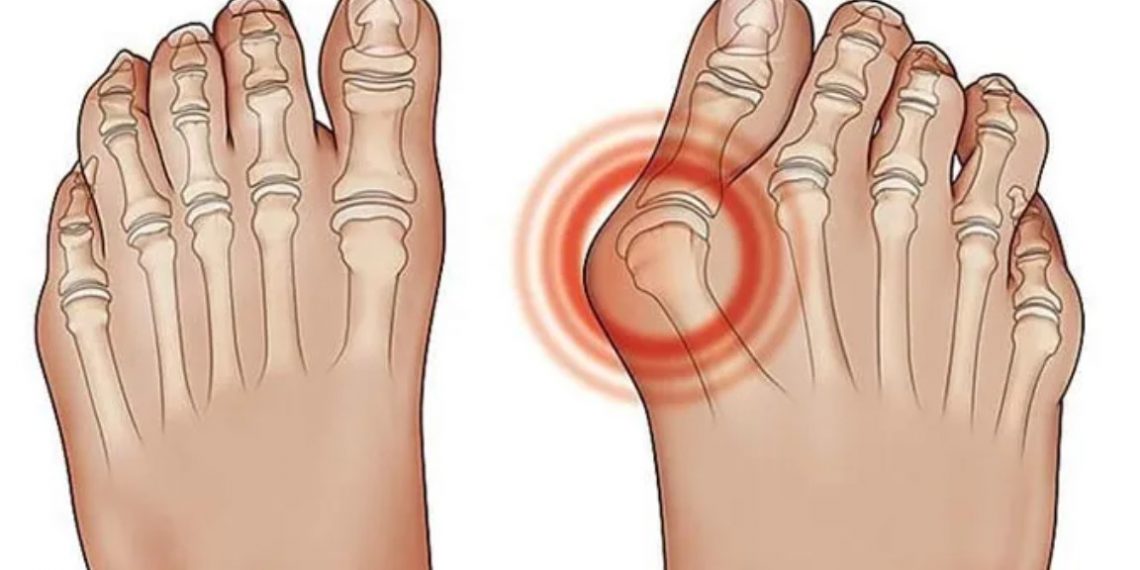Asam Urat Turun dalam Seminggu Tanpa Obat, Temukan Caranya di Sini