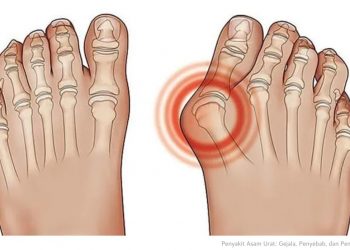 Asam Urat Turun dalam Seminggu Tanpa Obat, Temukan Caranya di Sini