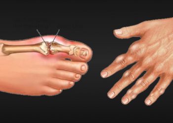 Waspadai, Ternyata ini Penyebab Asam Urat Naik