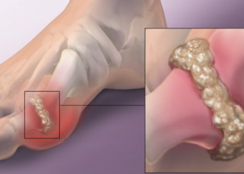 Cara Menurunkan Kadar Asam Urat Secara Alami, Salah Satunya Minum Banyak Air Putih