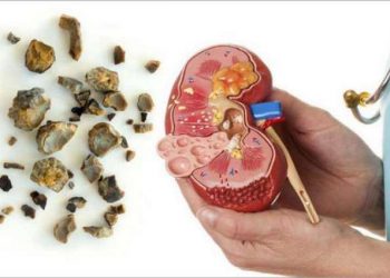 Batu Ginjal Disebabkan oleh Apa? Ini Jawabannya