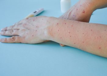 Kasusnya Terus Bertambah, Yuk Mengenal Penyakit Cacar Monyet yang Menghebohkan