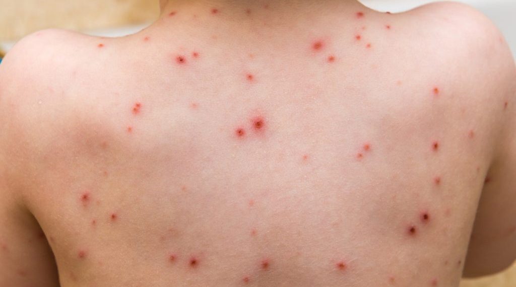 Begini Penyebab Cacar Air dan Pencegahannya