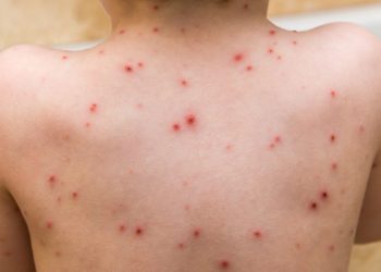 Begini Penyebab Cacar Air dan Pencegahannya