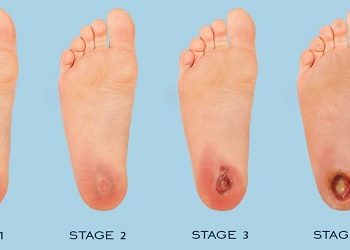 Ini Alasan Diebetes Menyerang Kaki, Ternyata Ada Cara Mencegahnya