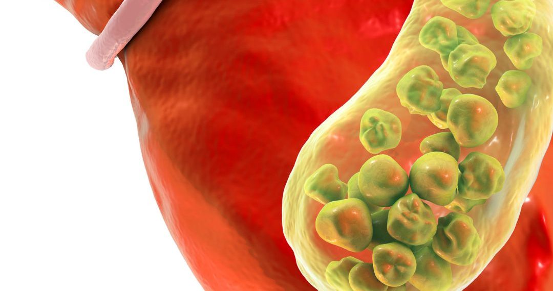 Ini Gejala Batu Empedu yang Kerap Diabaikan, Salah Satunya Kerap Mual Muntah saat Makan Makanan Berlemak