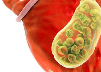 Ini Gejala Batu Empedu yang Kerap Diabaikan, Salah Satunya Kerap Mual Muntah saat Makan Makanan Berlemak