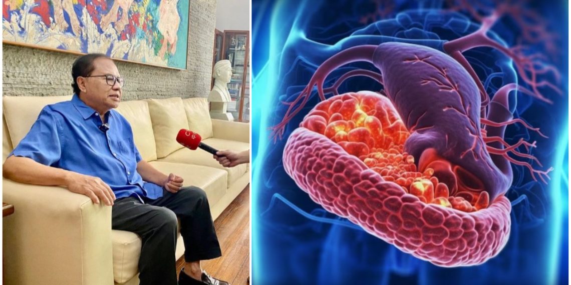 Diidap Mendiang Rizal Ramli, Ternyata ini Tingkat Keganasan Kanker Pankreas dan Implikasinya pada Kesehatan