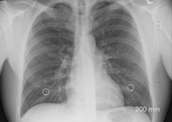 Begini Cara Mudah Mendeteksi Kanker Paru