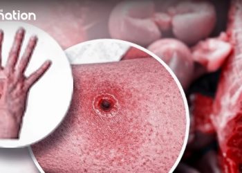 Kasusnya Meluas, Berawal dari Yogya kini Satu Keluarga di Klaten Dikabarkan Makan Daging Terpapar Antraks