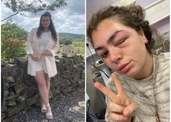 Horor! Wanita Cantik ini Terancam Buta Gara-gara Tergiur Sulam Alis di Klinik Kecantikan